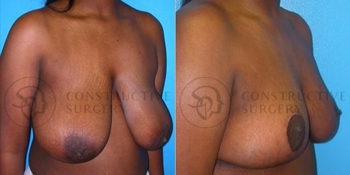 oblique View