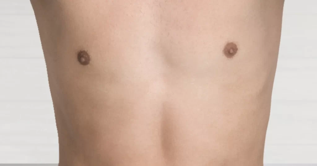 phalloplasty ftm before and after