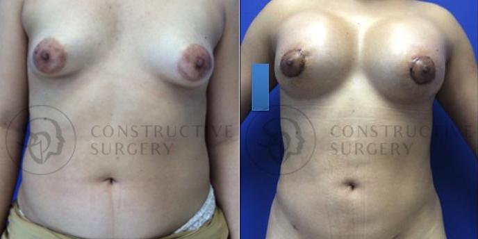PATIENT-000110 Liposuction, Breast Augmentation Age: 18-29 Gender: Female Ethnicity: White Height: 5'0" - 5'5" Weight: 151-175 lbs.