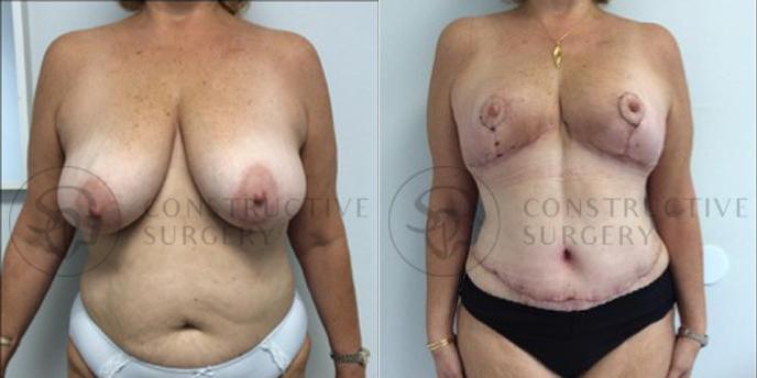 PATIENT-000071  Liposuction, Mommy Makeover, Tummy Tuck, Breast Lift  Age: 30-39 Gender: Female Ethnicity: White Height: 5'0" - 5'5" Weight: 176-200 lbs.