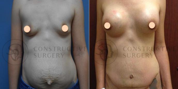 PATIENT-000072  Liposuction, Mommy Makeover, Tummy Tuck, Breast Lift  Age: 18-29 Gender: Female Ethnicity: White Height: 5'0" - 5'5" Weight: 126-150 lbs.