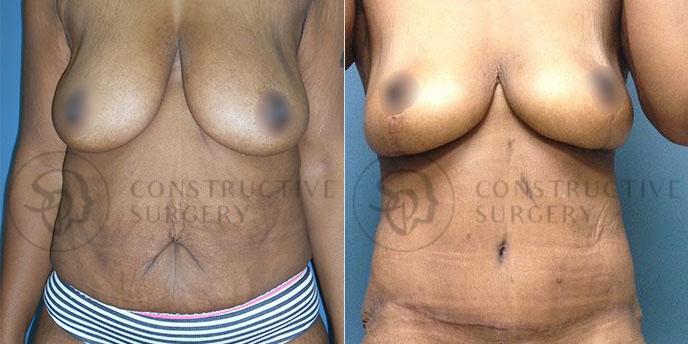 PATIENT-000234  Tummy Tuck, Breast Lift  Age: 40-49 Gender: Female Ethnicity: Black Height: 5'6" - 5'11" Weight: 151-175 lbs.