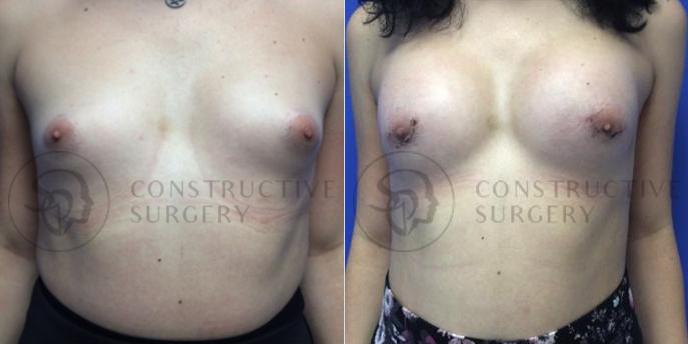 PATIENT-000105 Breast Augmentation Age: 18-29 Gender: Trans Woman Ethnicity: White Height: 5'0" - 5'5" Weight: 126-150 lbs