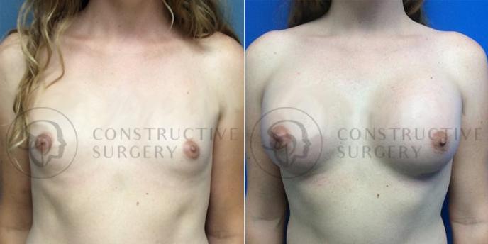 PATIENT-000107 Breast Augmentation Age: 18-29 Gender: Female Ethnicity: White Height: 5'6" - 5'11" Weight: 151-175 lbs.
