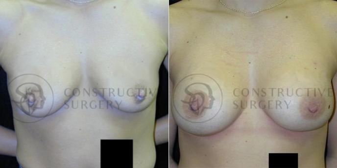 PATIENT-000108 Breast Augmentation Age: 18-29 Gender: Female Ethnicity: White Height: 5'6" - 5'11" Weight: 151-175 lbs.