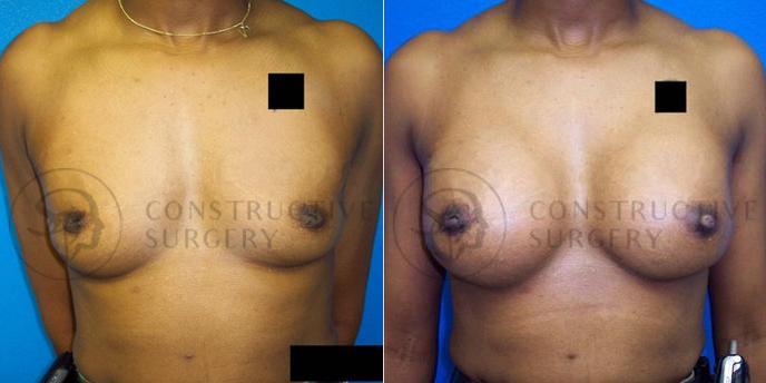 PATIENT-000111 Breast Augmentation Age: 30-39 Gender: Female Ethnicity: Hispanic Height: 5'6" - 5'11" Weight: 151-175 lbs.