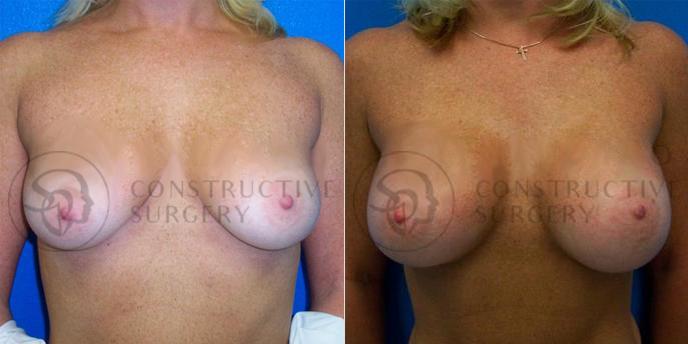 PATIENT-000106 Breast Augmentation Age: 30-39 Gender: Female Ethnicity: White Height: 5'6" - 5'11" Weight: 151-175 lbs.