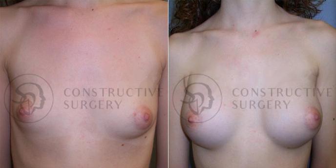 PATIENT-000109 Breast Augmentation Age: 18-29 Gender: Female Ethnicity: White Height: 5'0" - 5'5" Weight: 151-175 lbs.