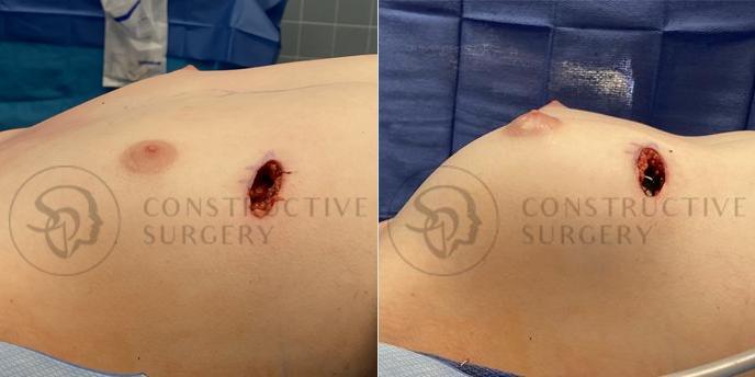 PATIENT-000103 Breast Augmentation Age: 18-29 Gender: Trans Woman Ethnicity: White Height: 5'0" - 5'5" Weight: 151-175 lbs.