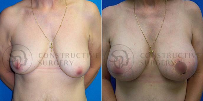 PATIENT-000151 Breast Augmentation, Breast Lift Age: 30-39 Gender: Female Ethnicity: White Height: 5'6" - 5'11" Weight: 151-175 lbs.
