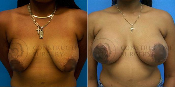 PATIENT-000149 Breast Augmentation, Breast Lift Age: 18-29 Gender: Female Ethnicity: Black Height: 5'6" - 5'11" Weight: 151-175 lbs.