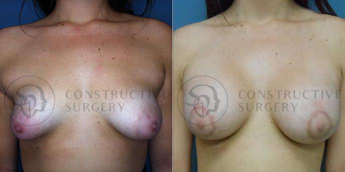 PATIENT-000150 Breast Augmentation, Breast Lift Age: 18-29 Gender: Female Ethnicity: White Height: 5'6" - 5'11" Weight: 126-150 lbs.