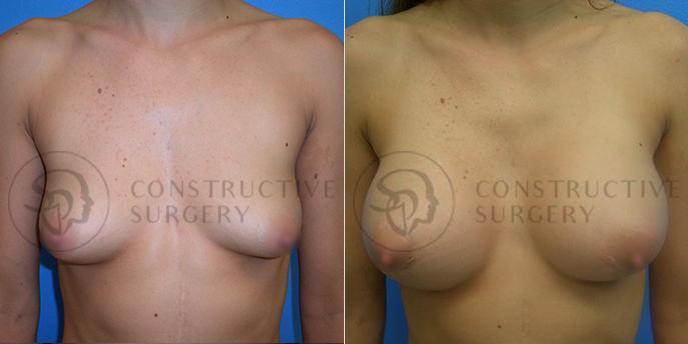 PATIENT-000144 Breast Augmentation Age: 18-29 Gender: Female Ethnicity: White Height: 5'6" - 5'11" Weight: 151-175 lbs.