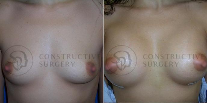 PATIENT-000142 Breast Augmentation Age: 18-29 Gender: Female Ethnicity: White Height: 5'6" - 5'11" Weight: 126-150 lbs.