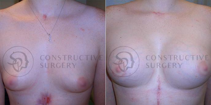 PATIENT-000137 Breast Augmentation Age: 18-29 Gender: Female Ethnicity: White Height: 5'6" - 5'11" Weight: 126-150 lbs.