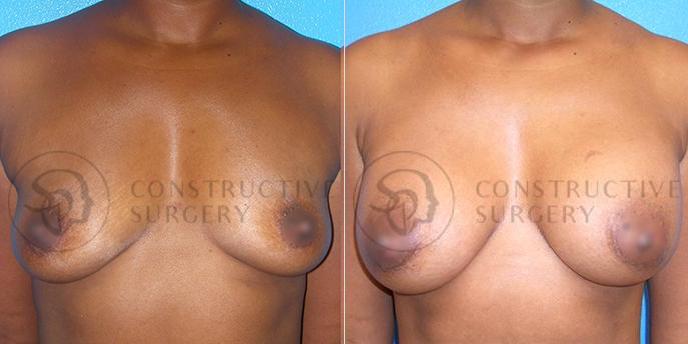 PATIENT-000136 Breast Augmentation Age: 18-29 Gender: Female Ethnicity: Black Height: 5'6" - 5'11" Weight: 126-150 lbs.