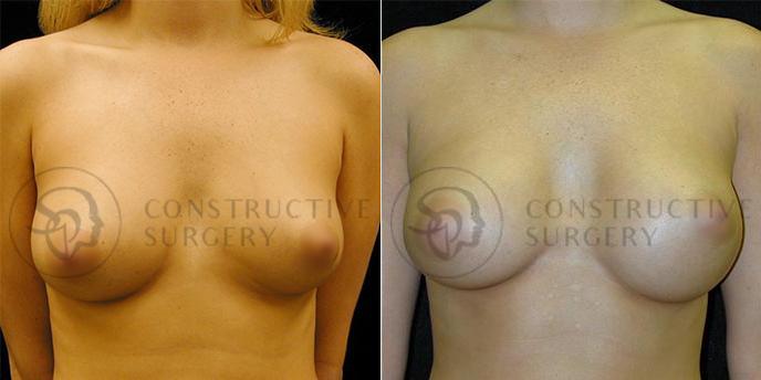PATIENT-000131 Breast Augmentation Age: 18-29 Gender: Female Ethnicity: White Height: 5'6" - 5'11" Weight: 126-150 lbs.