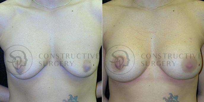 PATIENT-000132 Breast Augmentation Age: 18-29 Gender: Female Ethnicity: White Height: 5'6" - 5'11" Weight: 126-150 lbs.