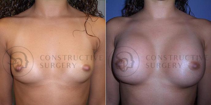 PATIENT-000143 Breast Augmentation Age: 18-29 Gender: Female Ethnicity: White Height: 5'0" - 5'5" Weight: 126-150 lbs.