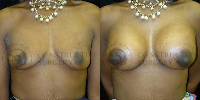 PATIENT-000147 Breast Augmentation Age: 18-29 Gender: Female Ethnicity: Black Height: 5'6" - 5'11" Weight: 151-175 lbs.