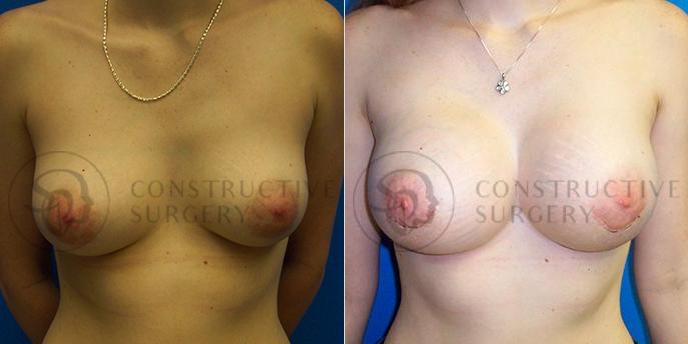 PATIENT-000135 Breast Augmentation Age: 18-29 Gender: Female Ethnicity: White Height: 5'6" - 5'11" Weight: 151-175 lbs.