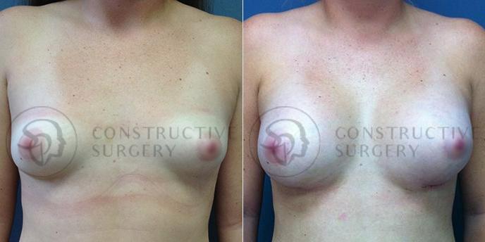 PATIENT-000140 Breast Augmentation Age: 18-29 Gender: Female Ethnicity: White Height: 5'6" - 5'11" Weight: 126-150 lbs.