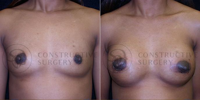 PATIENT-000148 Breast Augmentation Age: 18-29 Gender: Female Ethnicity: White Height: 5'6" - 5'11" Weight: 151-175 lbs.