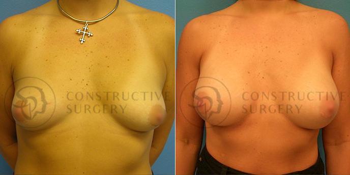 PATIENT-000145 Breast Augmentation Age: 18-29 Gender: Female Ethnicity: White Height: 5'6" - 5'11" Weight: 151-175 lbs.