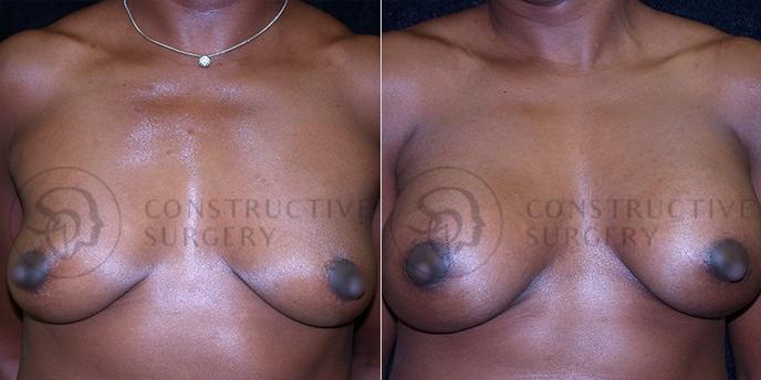 PATIENT-000139 Breast Augmentation Age: 18-29 Gender: Female Ethnicity: Black Height: 5'6" - 5'11" Weight: 151-175 lbs.