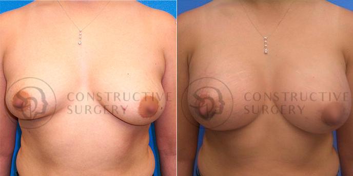 PATIENT-000133 Breast Augmentation Age: 18-29 Gender: Female Ethnicity: White Height: 5'6" - 5'11" Weight: 151-175 lbs.