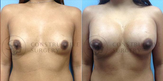PATIENT-000134 Breast Augmentation Age: 18-29 Gender: Female Ethnicity: White Height: 5'6" - 5'11" Weight: 151-175 lbs.