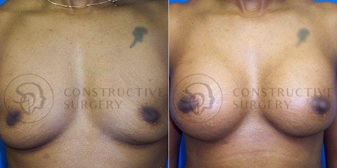 PATIENT-000138 Breast Augmentation Age: 18-29 Gender: Female Ethnicity: Black Height: 5'6" - 5'11" Weight: 151-175 lbs.