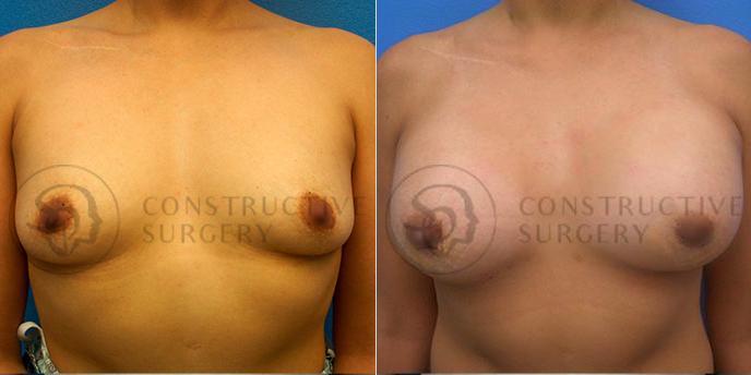 PATIENT-000141 Breast Augmentation Age: 18-29 Gender: Female Ethnicity: White Height: 5'6" - 5'11" Weight: 151-175 lbs.