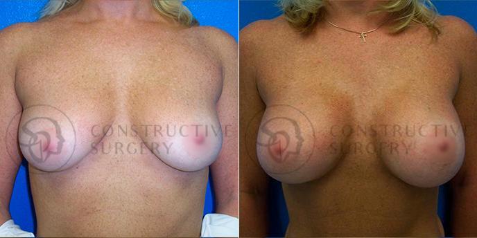 PATIENT-000146 Breast Augmentation Age: 18-29 Gender: Female Ethnicity: White Height: 5'6" - 5'11" Weight: 126-150 lbs.