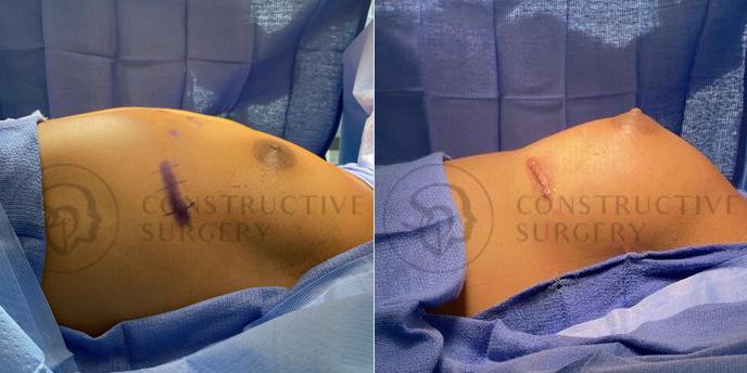 PATIENT-000103 Breast Augmentation Age: 18-29 Gender: Trans Woman Ethnicity: White Height: 5'0" - 5'5" Weight: 151-175 lbs.