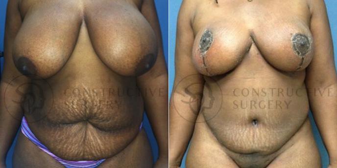 PATIENT-000069  Breast Lift, Breast Reduction  Age: 18-29 Gender: Female Ethnicity: Black Height: 5'0" - 5'5" Weight: 176-200 lbs.
