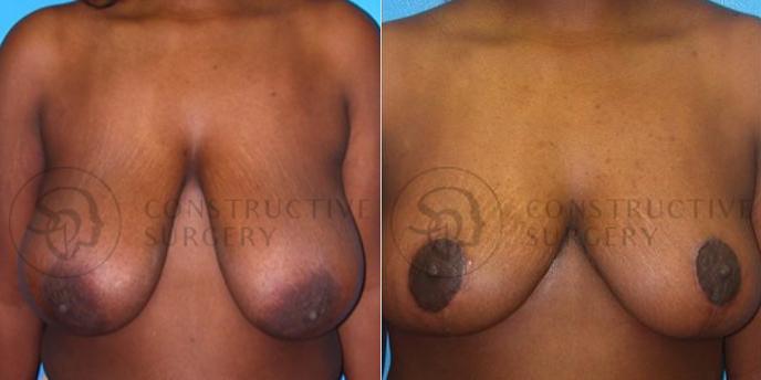 PATIENT-000099  Breast Lift, Breast Reduction  Age: 18-29 Gender: Female Ethnicity: Black Height: 5'0" - 5'5" Weight: 151-175 lbs.