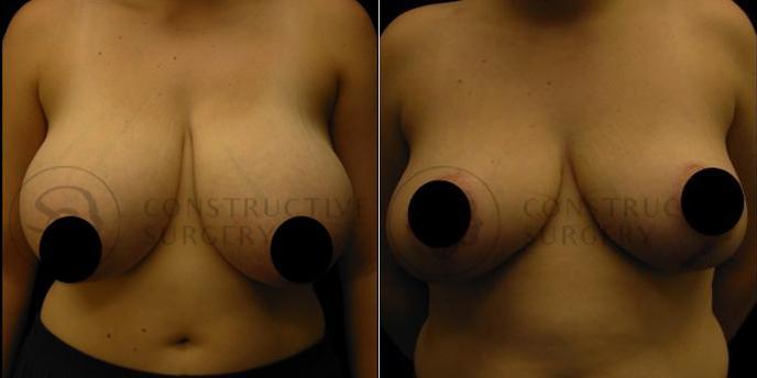 PATIENT-000100  Breast Lift, Breast Reduction  Age: 18-29 Gender: Female Ethnicity: White Height: 5'0" - 5'5" Weight: 151-175 lbs.