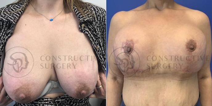 PATIENT-000101  Breast Reconstruction, Breast Lift, Implant Exchange  Age: 40-49 Gender: Female Ethnicity: White Height: 5'0" - 5'5" Weight: 151-175 lbs.