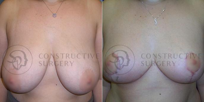 PATIENT-000206  Breast Reduction  Age: 30-39 Gender: Female Ethnicity: White Height: 5'6" - 5'11" Weight: 151-175 lbs.