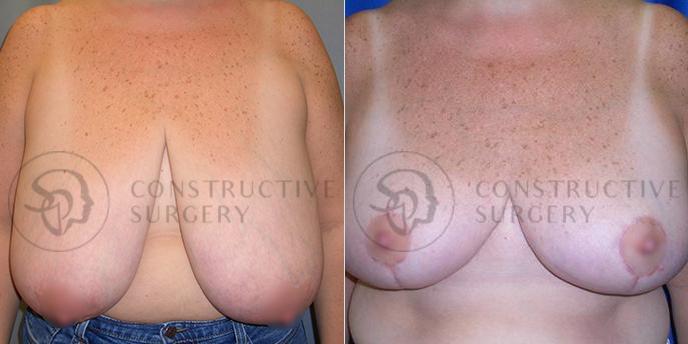 PATIENT-000222  Breast Reduction  Age: 40-49 Gender: Female Ethnicity: White Height: 5'6" - 5'11" Weight: 151-175 lbs.