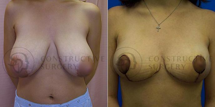 PATIENT-000207  Breast Reduction  Age: 30-39 Gender: Female Ethnicity: White Height: 5'6" - 5'11" Weight: 151-175 lbs.