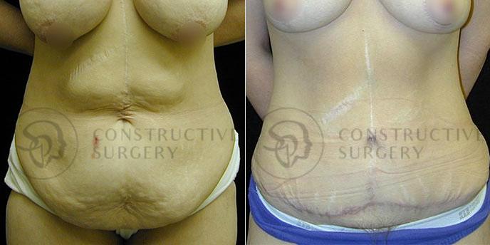 PATIENT-000245  Tummy Tuck, Breast Reduction  Age: 40-49 Gender: Female Ethnicity: White Height: 5'6" - 5'11" Weight: 151-175 lbs.