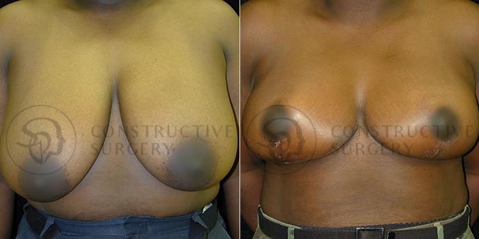 PATIENT-000203  Breast Reduction  Age: 40-49 Gender: Female Ethnicity: Black Height: 5'6" - 5'11" Weight: 151-175 lbs.