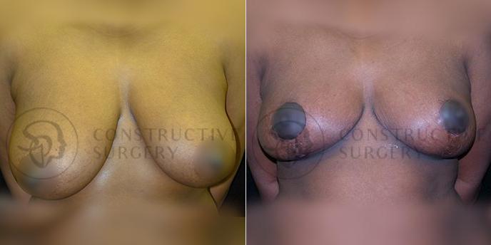 PATIENT-000204  Breast Reduction  Age: 30-39 Gender: Female Ethnicity: Black Height: 5'6" - 5'11" Weight: 151-175 lbs.