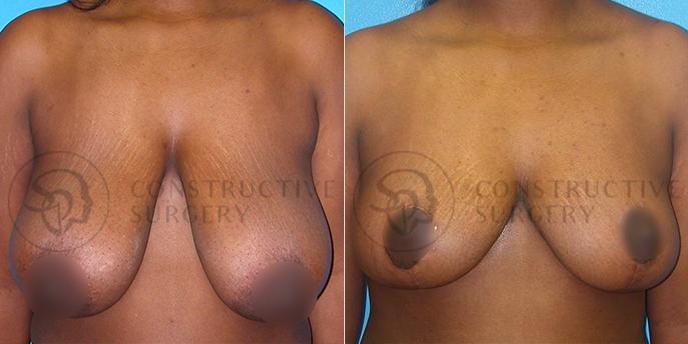 PATIENT-000198  Breast Reduction  Age: 30-39 Gender: Female Ethnicity: Black Height: 5'6" - 5'11" Weight: 151-175 lbs.