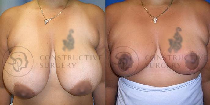 PATIENT-000197  Breast Reduction  Age: 40-49 Gender: Female Ethnicity: White Height: 5'6" - 5'11" Weight: 176-200 lbs.
