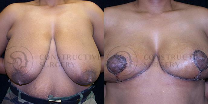 PATIENT-000200  Breast Reduction  Age: 40-49 Gender: Female Ethnicity: Black Height: 5'6" - 5'11" Weight: 151-175 lbs.