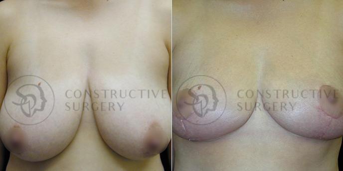 PATIENT-000224  Breast Reduction  Age: 40-49 Gender: Female Ethnicity: White Height: 5'6" - 5'11" Weight: 151-175 lbs.
