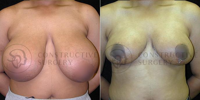 PATIENT-000202  Breast Reduction  Age: 40-49 Gender: Female Ethnicity: White Height: 5'6" - 5'11" Weight: 151-175 lbs.